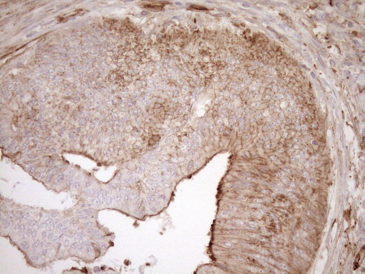 ASPDH Antibody - Immunohistochemical staining of paraffin-embedded Adenocarcinoma of Human colon tissue using anti-ASPDH mouse monoclonal antibody. (Heat-induced epitope retrieval by 1mM EDTA in 10mM Tris buffer. (pH8.5) at 120°C for 3 min. (1:150)