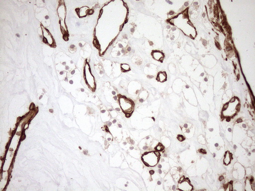 ASPDH Antibody - Immunohistochemical staining of paraffin-embedded Carcinoma of Human kidney tissue using anti-ASPDH mouse monoclonal antibody. (Heat-induced epitope retrieval by 1mM EDTA in 10mM Tris buffer. (pH8.5) at 120°C for 3 min. (1:150)