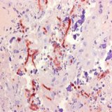 Aspergillus Antibody - Human Placental tissue presenting aspergillosis stained with Mouse anti-Aspergillus