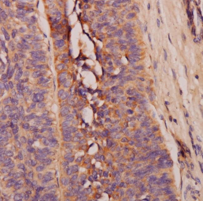 Asprosin Antibody - Immunohistochemistry of paraffin-embedded human liver cancer tissue slide using asprosin antibody at dilution of 1:400