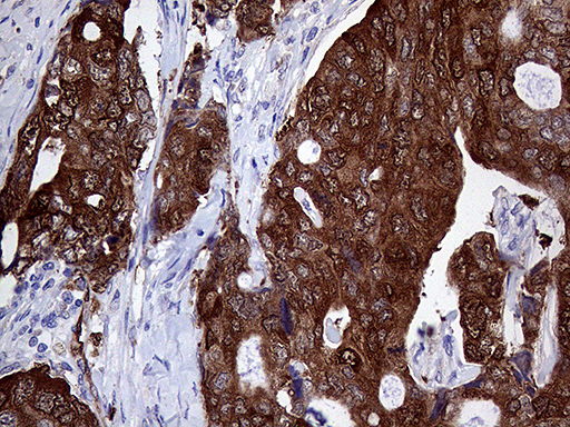 ASS1 / ASS Antibody - Immunohistochemical staining of paraffin-embedded Adenocarcinoma of Human breast tissue tissue using anti-ASS1 mouse monoclonal antibody. (Heat-induced epitope retrieval by 1mM EDTA in 10mM Tris buffer. (pH8.5) at 120°C for 3 min. (1:2000)