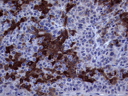 ASS1 / ASS Antibody - Immunohistochemical staining of paraffin-embedded Carcinoma of Human liver tissue using anti-ASS1 mouse monoclonal antibody. (Heat-induced epitope retrieval by 1mM EDTA in 10mM Tris buffer. (pH8.5) at 120°C for 3 min. (1:500)
