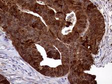 ASS1 / ASS Antibody - Immunohistochemical staining of paraffin-embedded Adenocarcinoma of Human colon tissue using anti-ASS1 mouse monoclonal antibody. (Heat-induced epitope retrieval by 1mM EDTA in 10mM Tris buffer. (pH8.5) at 120°C for 3 min. (1:2000)