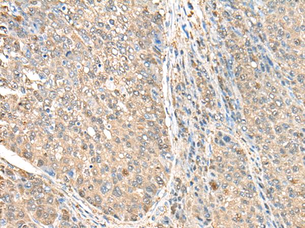 ASS1 / ASS Antibody - Immunohistochemistry of paraffin-embedded Human liver cancer tissue  using ASS1 Polyclonal Antibody at dilution of 1:35(×200)