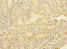 ASTL Antibody - Immunohistochemistry of paraffin-embedded human endometrial cancer using ASTL Antibody at dilution of 1:100
