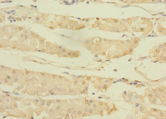 ASTL Antibody - Immunohistochemistry of paraffin-embedded human gastric cancer using ASTL Antibody at dilution of 1:100