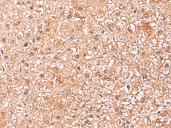 ASTN2 Antibody - Immunohistochemistry of paraffin-embedded Human liver cancer tissue  using ASTN2 Polyclonal Antibody at dilution of 1:80(×200)