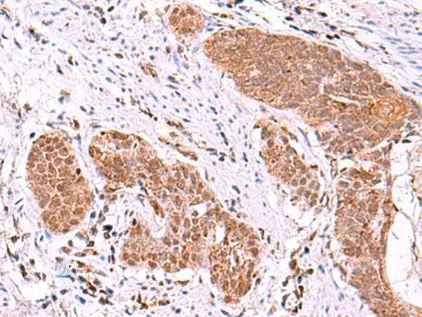 ASTN2 Antibody - Immunohistochemistry of paraffin-embedded Human esophagus cancer tissue  using ASTN2 Polyclonal Antibody at dilution of 1:80(×200)