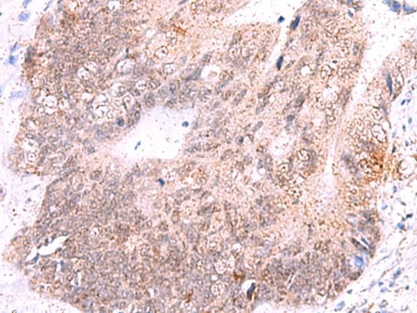 ASTN2 Antibody - Immunohistochemistry of paraffin-embedded Human colorectal cancer tissue  using ASTN2 Polyclonal Antibody at dilution of 1:55(×200)