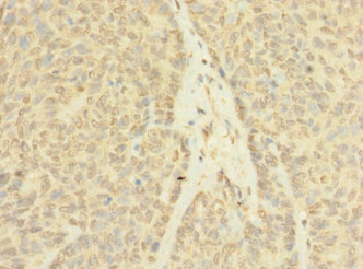 ASZ1 / Orf3 Antibody - Immunohistochemistry of paraffin-embedded human ovarian cancer using ASZ1 Antibody at dilution of 1:100