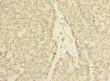 ASZ1 / Orf3 Antibody - Immunohistochemistry of paraffin-embedded human ovarian cancer using ASZ1 Antibody at dilution of 1:100