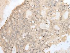 ATAC1 / ZZZ3 Antibody - Immunohistochemistry of paraffin-embedded Human colorectal cancer tissue  using ZZZ3 Polyclonal Antibody at dilution of 1:50(×200)