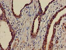 ATAD1 Antibody - Immunohistochemistry of paraffin-embedded human prostate cancer at dilution of 1:100