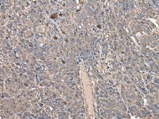 ATAD1 Antibody - Immunohistochemistry of paraffin-embedded Human liver cancer tissue  using ATAD1 Polyclonal Antibody at dilution of 1:50(×200)