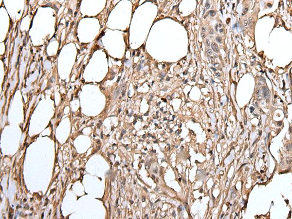 ATAD1 Antibody - Immunohistochemistry of paraffin-embedded Human colorectal cancer tissue  using ATAD1 Polyclonal Antibody at dilution of 1:50(×200)