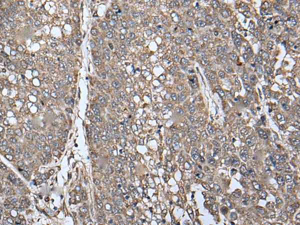 ATAD1 Antibody - Immunohistochemistry of paraffin-embedded Human liver cancer tissue  using ATAD1 Polyclonal Antibody at dilution of 1:65(×200)