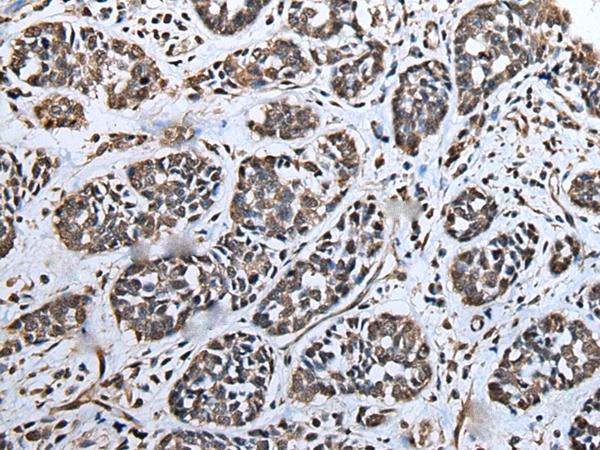 ATAD1 Antibody - Immunohistochemistry of paraffin-embedded Human esophagus cancer tissue  using ATAD1 Polyclonal Antibody at dilution of 1:65(×200)