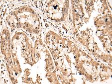 ATAD3A Antibody - Immunohistochemistry of paraffin-embedded Human liver cancer tissue  using ATAD3A Polyclonal Antibody at dilution of 1:40(×200)