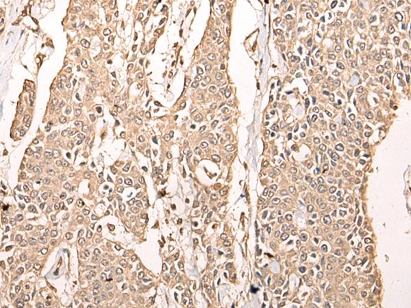ATAD3A Antibody - Immunohistochemistry of paraffin-embedded Human prost ate cancer tissue  using ATAD3A Polyclonal Antibody at dilution of 1:40(×200)