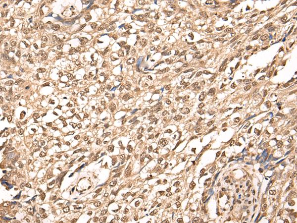 ATAD3A Antibody - Immunohistochemistry of paraffin-embedded Human lung cancer tissue  using ATAD3A Polyclonal Antibody at dilution of 1:30(×200)