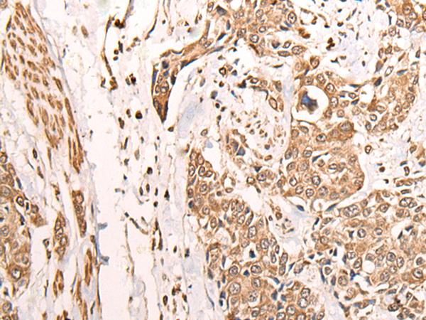 ATAD3A Antibody - Immunohistochemistry of paraffin-embedded Human prost ate cancer tissue  using ATAD3A Polyclonal Antibody at dilution of 1:30(×200)