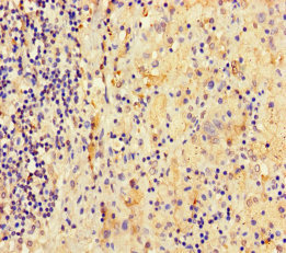 ATAD3C Antibody - Immunohistochemistry of paraffin-embedded human lung cancer using ATAD3C Antibody at dilution of 1:100