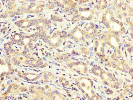 ATE1 Antibody - Immunohistochemistry image at a dilution of 1:200 and staining in paraffin-embedded human liver cancer performed on a Leica BondTM system. After dewaxing and hydration, antigen retrieval was mediated by high pressure in a citrate buffer (pH 6.0) . Section was blocked with 10% normal goat serum 30min at RT. Then primary antibody (1% BSA) was incubated at 4 °C overnight. The primary is detected by a biotinylated secondary antibody and visualized using an HRP conjugated SP system.
