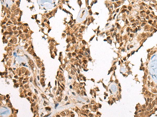 ATE1 Antibody - Immunohistochemistry of paraffin-embedded Human ovarian cancer tissue  using ATE1 Polyclonal Antibody at dilution of 1:60(×200)