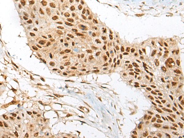 ATE1 Antibody - Immunohistochemistry of paraffin-embedded Human esophagus cancer tissue  using ATE1 Polyclonal Antibody at dilution of 1:60(×200)