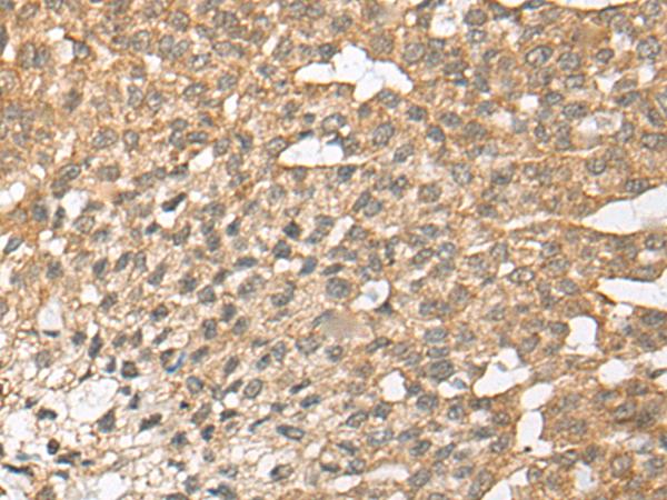 ATE1 Antibody - Immunohistochemistry of paraffin-embedded Human liver cancer tissue  using ATE1 Polyclonal Antibody at dilution of 1:45(×200)