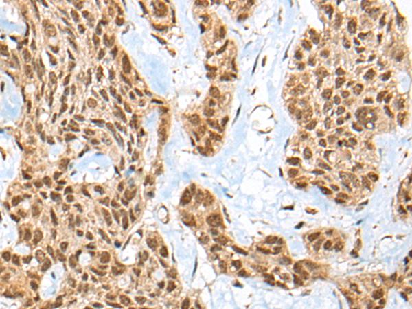 ATE1 Antibody - Immunohistochemistry of paraffin-embedded Human esophagus cancer tissue  using ATE1 Polyclonal Antibody at dilution of 1:45(×200)