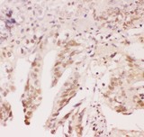 ATF1 Antibody - ATF1 antibody IHC-paraffin: Human Intestinal Cancer Tissue.