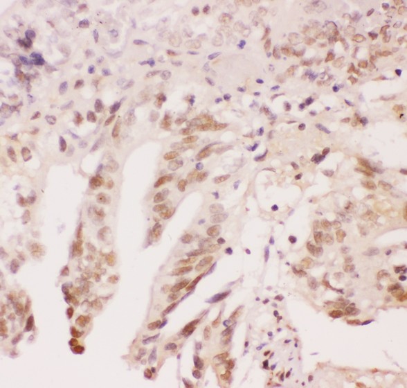ATF1 Antibody - ATF1 antibody IHC-paraffin: Human Intestinal Cancer Tissue.