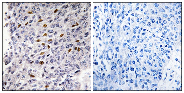 ATF1 Antibody - Immunohistochemistry analysis of paraffin-embedded human lung carcinoma tissue, using ATF1 Antibody. The picture on the right is blocked with the synthesized peptide.