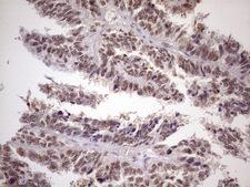 ATF1 Antibody - Immunohistochemical staining of paraffin-embedded Adenocarcinoma of Human ovary tissue using anti-ATF1 mouse monoclonal antibody. (Heat-induced epitope retrieval by 1mM EDTA in 10mM Tris buffer. (pH8.5) at 120 oC for 3 min. (1:150)