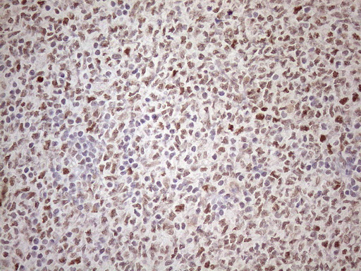 ATF1 Antibody - Immunohistochemical staining of paraffin-embedded Human lymphoma tissue using anti-ATF1 mouse monoclonal antibody. (Heat-induced epitope retrieval by 1mM EDTA in 10mM Tris buffer. (pH8.5) at 120 oC for 3 min. (1:150)