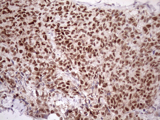 ATF1 Antibody - Immunohistochemical staining of paraffin-embedded Adenocarcinoma of Human endometrium tissue using anti-ATF1 mouse monoclonal antibody. (Heat-induced epitope retrieval by 1mM EDTA in 10mM Tris buffer. (pH8.5) at 120 oC for 3 min. (1:150)
