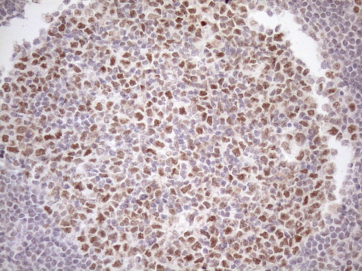ATF1 Antibody - Immunohistochemical staining of paraffin-embedded Human lymph node tissue within the normal limits using anti-ATF1 mouse monoclonal antibody. (Heat-induced epitope retrieval by 1mM EDTA in 10mM Tris buffer. (pH8.5) at 120 oC for 3 min. (1:150)