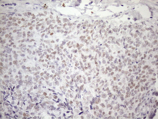 ATF1 Antibody - Immunohistochemical staining of paraffin-embedded Adenocarcinoma of Human endometrium tissue using anti-ATF1 mouse monoclonal antibody. (Heat-induced epitope retrieval by 1mM EDTA in 10mM Tris buffer. (pH8.5) at 120 oC for 3 min. (1:150)