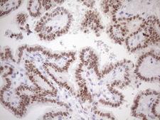 ATF1 Antibody - Immunohistochemical staining of paraffin-embedded Carcinoma of Human thyroid tissue using anti-ATF1 mouse monoclonal antibody. (Heat-induced epitope retrieval by 1mM EDTA in 10mM Tris buffer. (pH8.5) at 120 oC for 3 min. (1:150)
