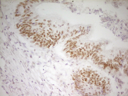 ATF1 Antibody - Immunohistochemical staining of paraffin-embedded Adenocarcinoma of Human colon tissue using anti-ATF1 mouse monoclonal antibody. (Heat-induced epitope retrieval by 1 mM EDTA in 10mM Tris, pH8.5, 120C for 3min,