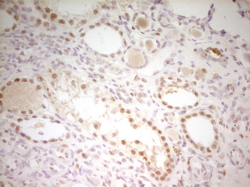 ATF1 Antibody - Immunohistochemical staining of paraffin-embedded Human Kidney tissue within the normal limits using anti-ATF1 mouse monoclonal antibody. (Heat-induced epitope retrieval by 1 mM EDTA in 10mM Tris, pH8.5, 120C for 3min,