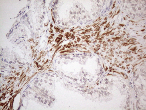 ATF1 Antibody - Immunohistochemical staining of paraffin-embedded Human prostate tissue within the normal limits using anti-ATF1 mouse monoclonal antibody. (Heat-induced epitope retrieval by 1mM EDTA in 10mM Tris buffer. (pH8.5) at 120°C for 3 min. (1:150)