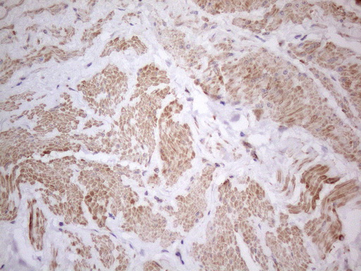 ATF1 Antibody - Immunohistochemical staining of paraffin-embedded Carcinoma of Human bladder tissue using anti-ATF1 mouse monoclonal antibody. (Heat-induced epitope retrieval by 1mM EDTA in 10mM Tris buffer. (pH8.5) at 120°C for 3 min. (1:150)