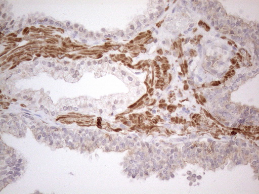 ATF1 Antibody - Immunohistochemical staining of paraffin-embedded Carcinoma of Human prostate tissue using anti-ATF1 mouse monoclonal antibody. (Heat-induced epitope retrieval by 1mM EDTA in 10mM Tris buffer. (pH8.5) at 120°C for 3 min. (1:150)