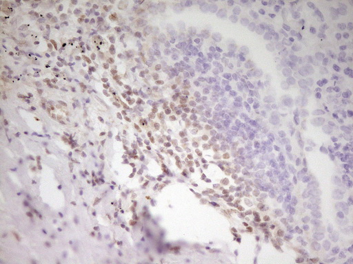 ATF1 Antibody - Immunohistochemical staining of paraffin-embedded Carcinoma of Human lung tissue using anti-ATF1 mouse monoclonal antibody. (Heat-induced epitope retrieval by 1 mM EDTA in 10mM Tris, pH8.5, 120C for 3min,