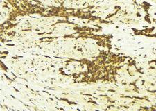 ATF1 Antibody - 1:100 staining human breast carcinoma tissue by IHC-P. The sample was formaldehyde fixed and a heat mediated antigen retrieval step in citrate buffer was performed. The sample was then blocked and incubated with the antibody for 1.5 hours at 22°C. An HRP conjugated goat anti-rabbit antibody was used as the secondary.