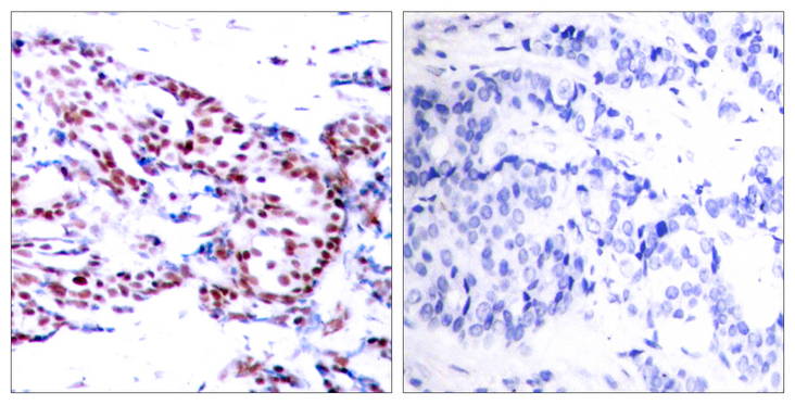 ATF2 Antibody - Immunohistochemistry analysis of paraffin-embedded human breast carcinoma tissue, using ATF2 Antibody. The picture on the right is blocked with the synthesized peptide.