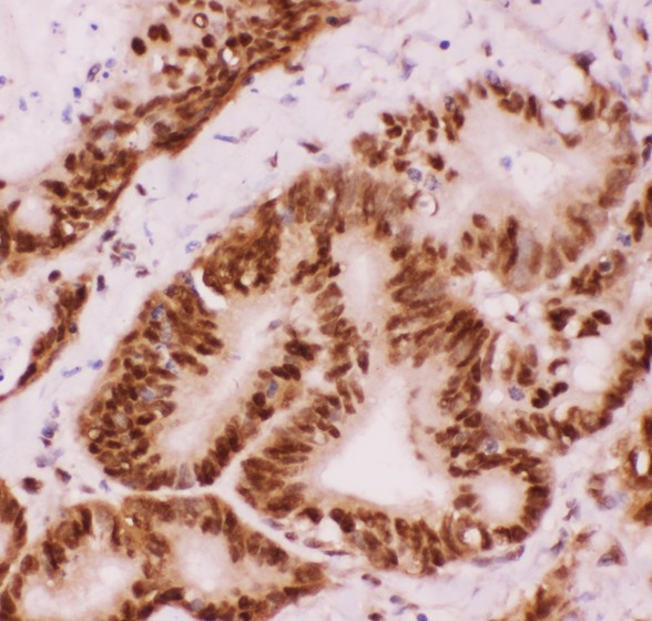 ATF2 Antibody - ATF2 antibody IHC-paraffin: Human Intestinal Cancer Tissue.