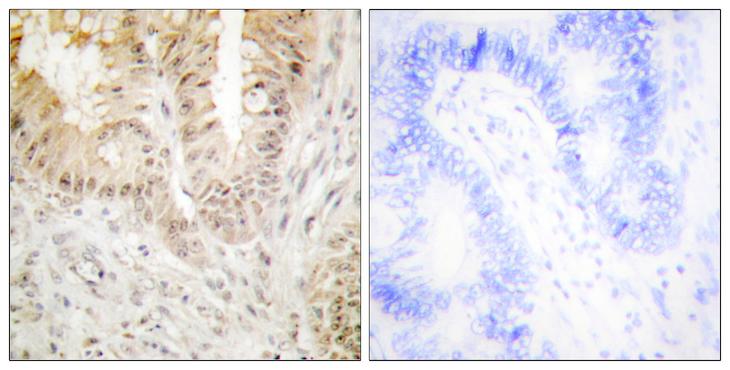 ATF2 Antibody - Peptide - + Immunohistochemistry analysis of paraffin-embedded human colon carcinoma tissue using ATF2 antibody.